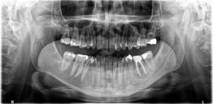根管治療を行なって約6ヶ月後のレントゲン写真